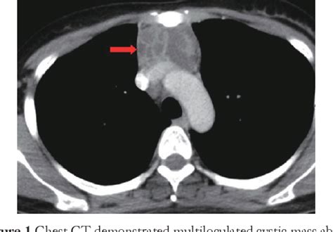Figure 1 From Primary Thymic Mucosa Associated Lymphoid Tissue Lymphoma