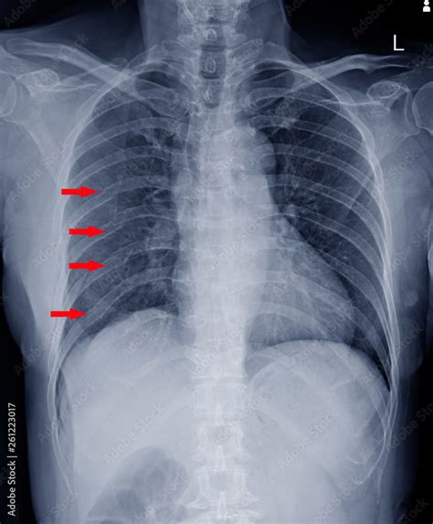 X Ray Chest Finding Multiple Fracture Ribs On Red Arrows Mark Stock Photo Adobe Stock