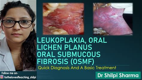 Quick Diagnosis And Basic Treatment Of Leukoplakia Lichen Planus And