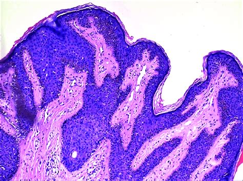 The Fl At Topped Tips Of The Papillomatous Epidermis Of An Epidermal