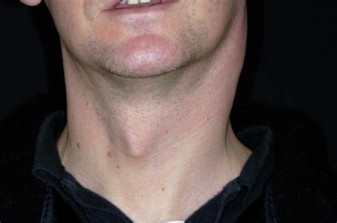 Pictures Of Swollen Lymph Nodes In Neck Canine Lymphoma Risk Factors