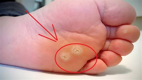 How To Get Rid Of Plantar Warts With Duct Tape Youtube