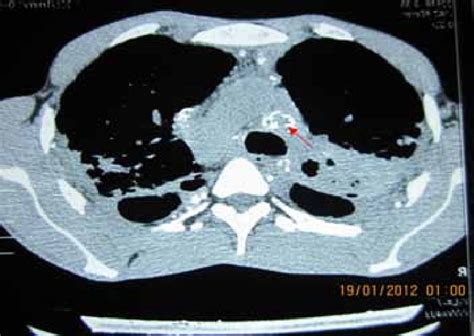 Egg Shell Calcification Seen In The Mediastinal And Hilar Lymph Nodes