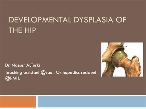 Ppt Developmental Dysplasia Of The Hip Powerpoint Presentation Free