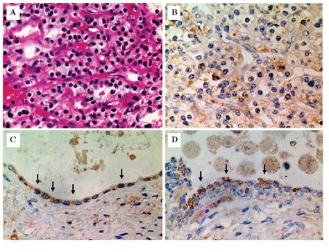 Figure 2 From Erythropoietin Production In Renal Cell Carcinoma And