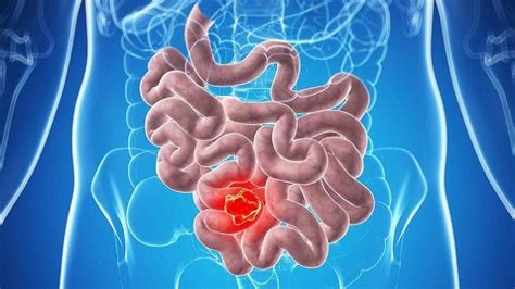 Bowel Cancer Types Symptoms Causes Stages Diagnosis Treatment And