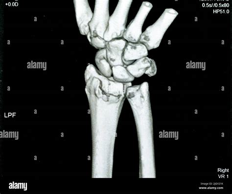 Fractured Right Wrist X Ray Hi Res Stock Photography And Images Alamy