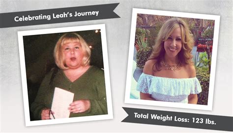 Before And After Rny With Leah Losing 123 Pounds Obesityhelp