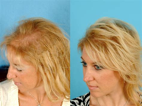 Don't let thinning hair cramp your style! Before and after - Eek! Hair loss in women: Top 7 risk ...