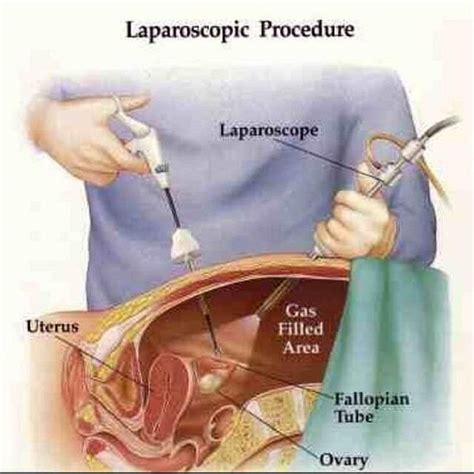 Laparoscopic Hysterectomy Treatment Getwellgo India S Best