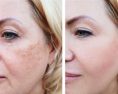 Dark Spots And Uneven Tone Skin Concern