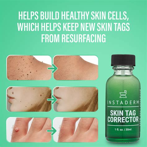 buy instaderm skin tag and mole remover fast acting medical grade skin tag remover serum wart