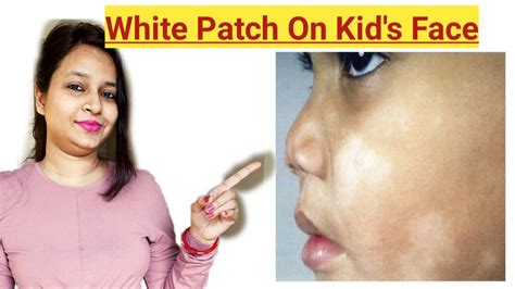 White Patch On Kids Face What Is Pityriasis Alba White Spot On