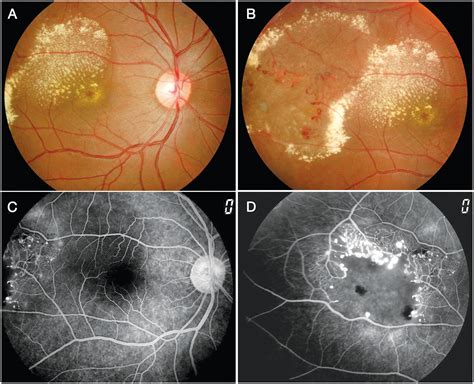 Ultra‐wide Field Imaging In The Diagnosis And Management Of Adult‐onset