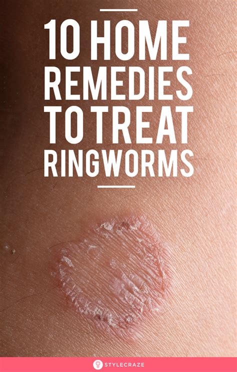 10 Best Natural Home Remedies For Ringworm Treatment Artofit
