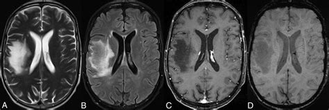 Susceptibility Weighted Mr Imaging Hypointense Rim In Progressive