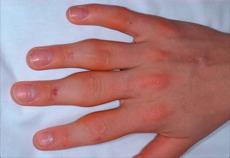 Common Finger Injuries From Rock Climbing Dr James Lee Pt Dpt