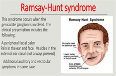 Syndrome Ramsay Hunt
