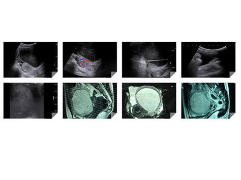 VIETNAMESE MEDIC ULTRASOUND CASE PID With PELVIC MASS Dr PHAN