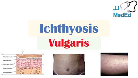 Ichthyosis Vulgaris Causes Signs And Symptoms Diagnosis Treatment