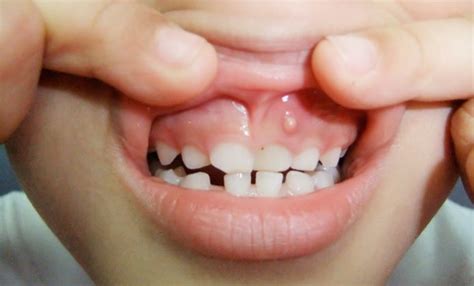 What Are Gum Boils And Causes How Can They Be Treated