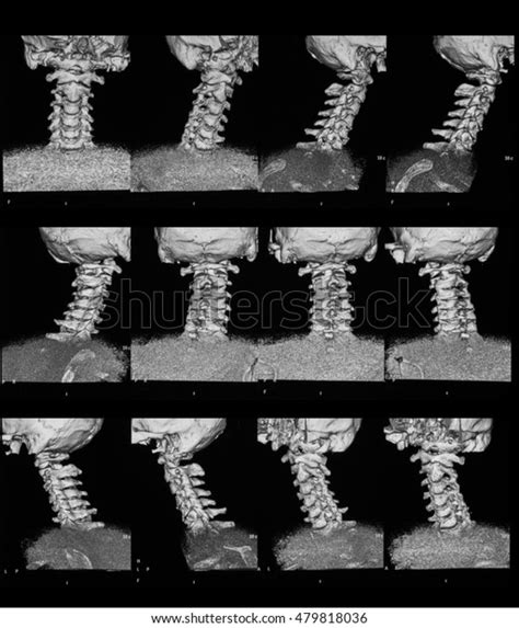 3d Ct Scan Cervical Spine Cspine Stock Photo Edit Now 479818036