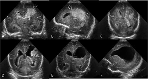 Grade Iii Gmh Ivh Pvhi Ultrasound Scan In A Preterm Infant Ga 24