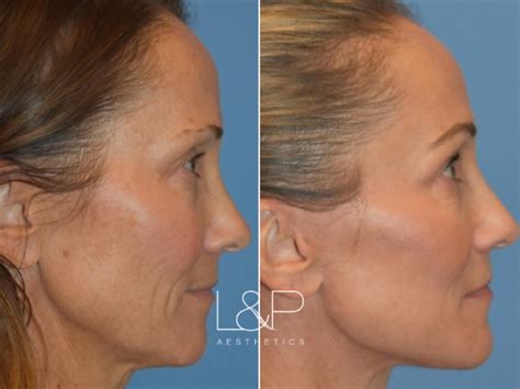 Facelift And Neck Lift Before And After Photos Case 21 Palo Alto And San