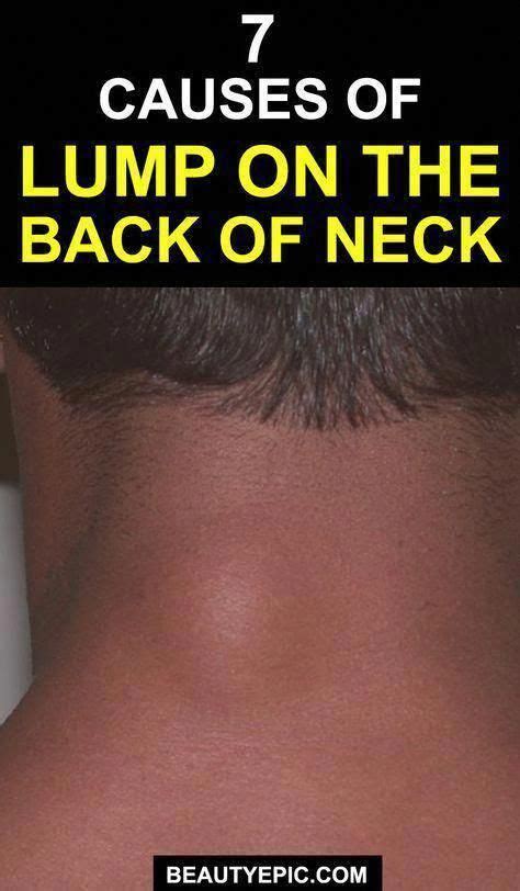Causes For Lump On The Back Of Neck Lumpbeneathskin Blacklumponskin