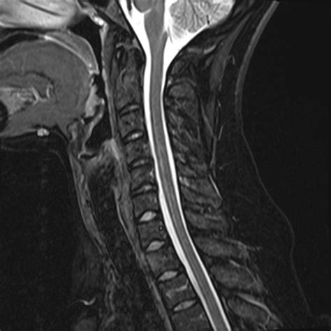 Image Gallery Normal Cervical Spine Mri