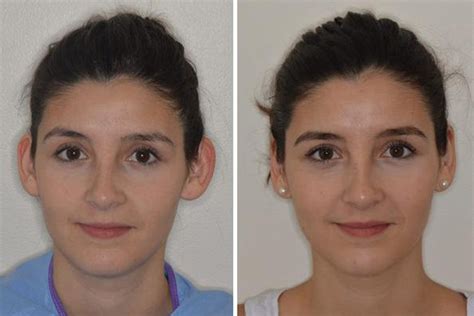 Otoplasty Miami Fl Ear Reshaping Surgery Dr Anthony Bared