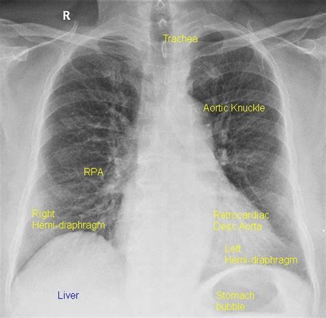 X Ray Chest Pa View Cxr Pa All About Cardiovascular System And