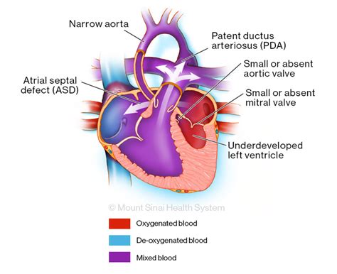 Hypoplastic Left Heart Syndrome Diagnosis And Treatment Mount Sinai