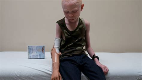 Tanzania Attacked For Body Parts Albino Children Get New Limbs In Us