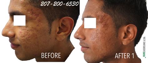 Microneedling For Acne Scarring Maine Laser Clinic