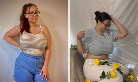 Student With 32k Breasts Told To Lose Three Stone Before Reduction Uk
