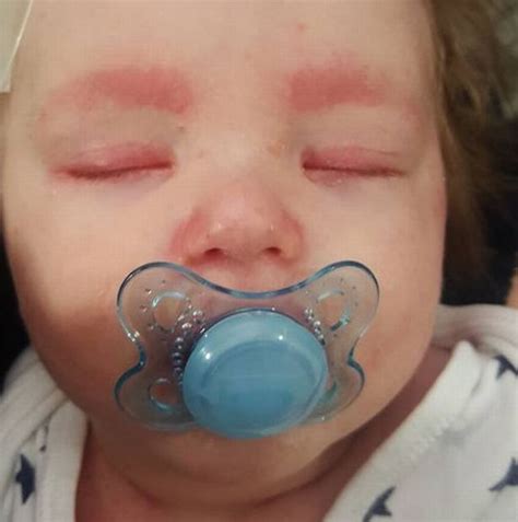 These Terrifying Photos Show Meningitis Rash Overwhelming Babys Body