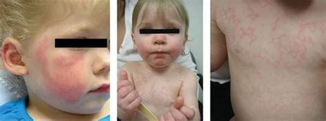 Viral Exanthems Dermatologic Strange And Schafermeyers Pediatric