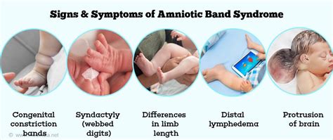 Amniotic Band Syndrome Causes Risk Factors Symptoms Diagnosis