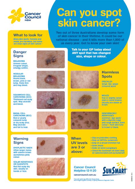 Chart Abcde Melanoma The Abcde Rule Of Skin Cancer Afd Get The