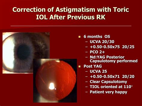 PPT Correction Of Astigmatism With Toric IOL After Previous RK PowerPoint Presentation ID