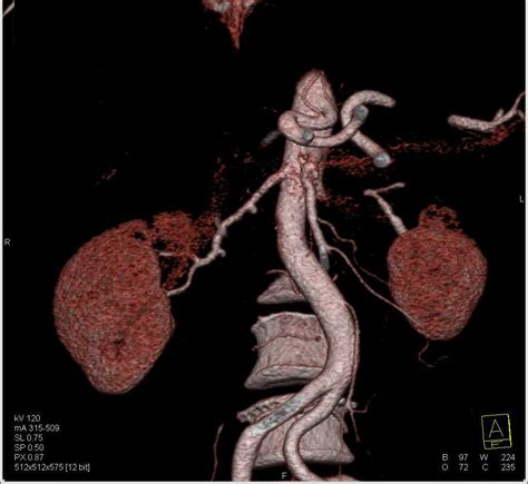 Fibromuscular Dysplasia Of The Renal Arteries FMD Vascular Case