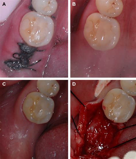 A Non Healing Tooth Socket Healthy Is Rich