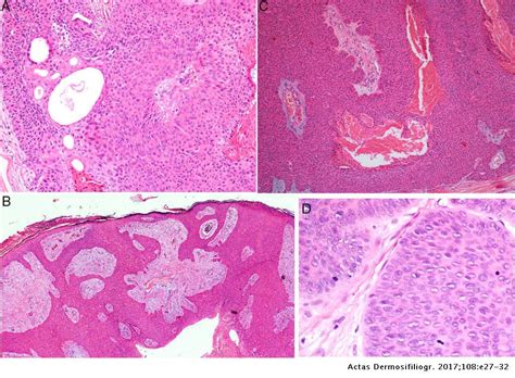 Eccrine Porocarcinoma Patient Characteristics Clinical And