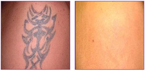The Facts About Laser Tattoo Removal The Fab Clinic