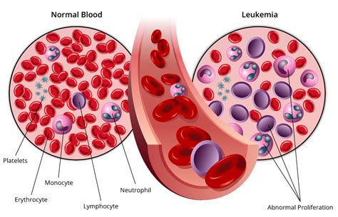 What Is Leukemia Health And Care