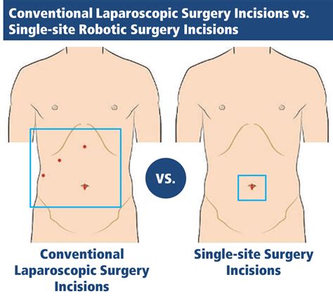 Abdominal Surgical Incisions