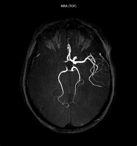 Mri In Ms Stroke Brain Tumor Fieldstrength Philips