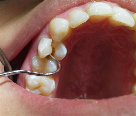 Que Hacer Ante Una Fractura Dental Médicos En Merida