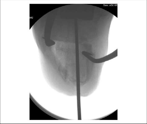 Intraoperative Fluoroscopic Harris Heel View Demonstrating Guidewire